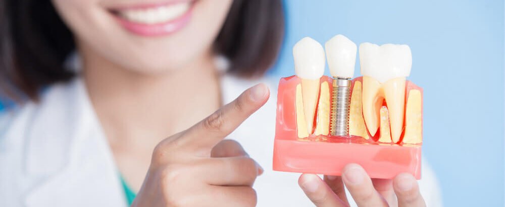 Dental Implant Clinic in Baner | Dental Implantologist in Baner