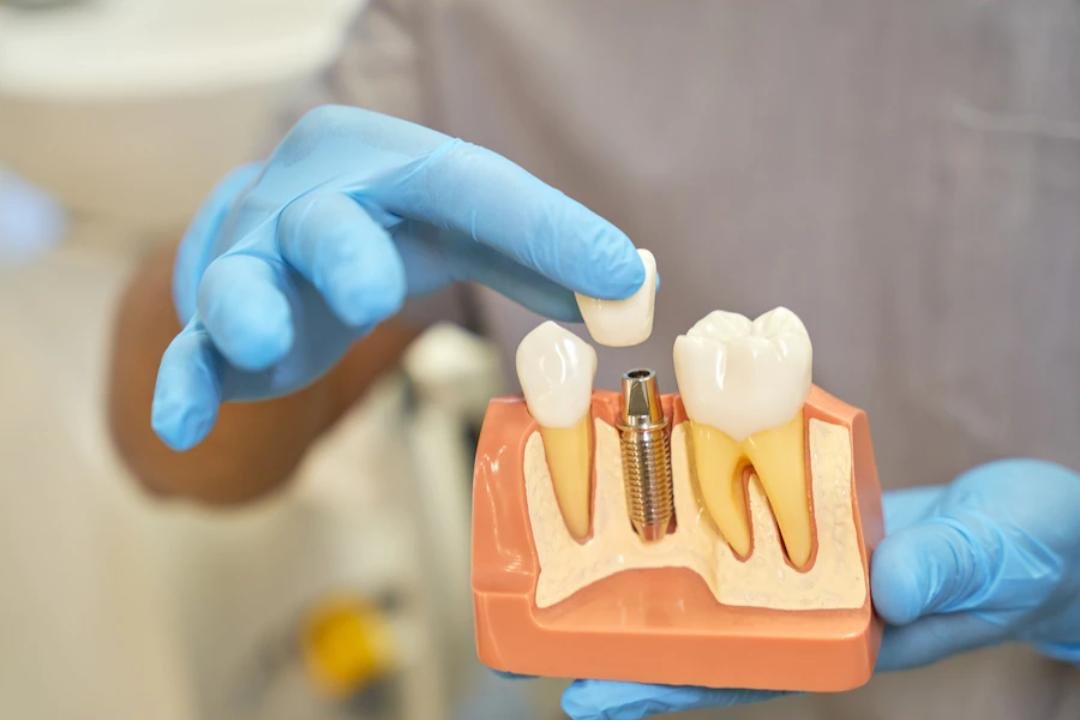 Best Dental Implant Clinic in Baner