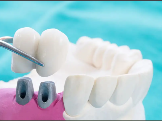 Fixed Denture or Removable: What Should You Choose?