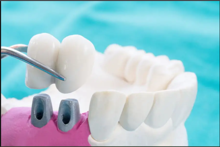 Fixed Denture Or Removable: What Should You Choose?