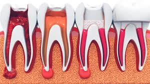 The Impact of Root Canal Treatment on  Chewing Ability