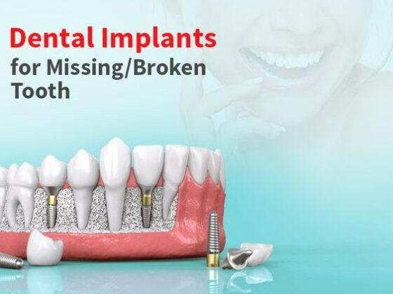 Revolutionize Your Smile: Dental Implants for Missing Teeth