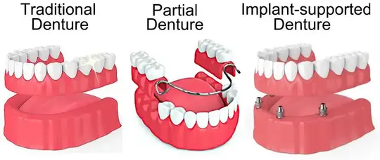 Traditional vs. Implant Dentures: Dental Care’s Impact