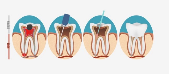 root canal process