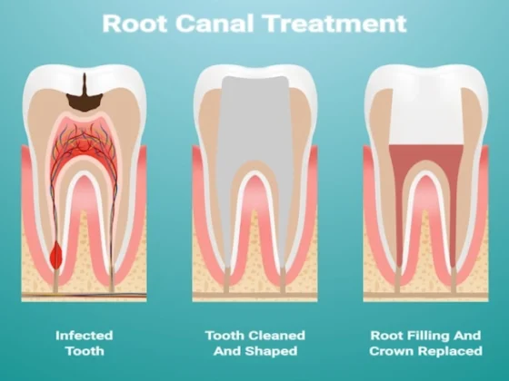 Post Root Canal Pain Explained