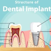 Exploring the Simplicity of Dental Implant Surgery