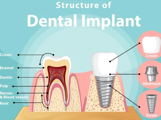 The Simplicity of Dental Implant Surgery