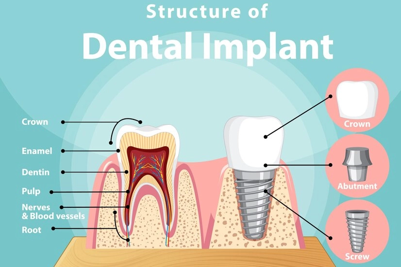 Exploring the Simplicity of Dental Implant Surgery