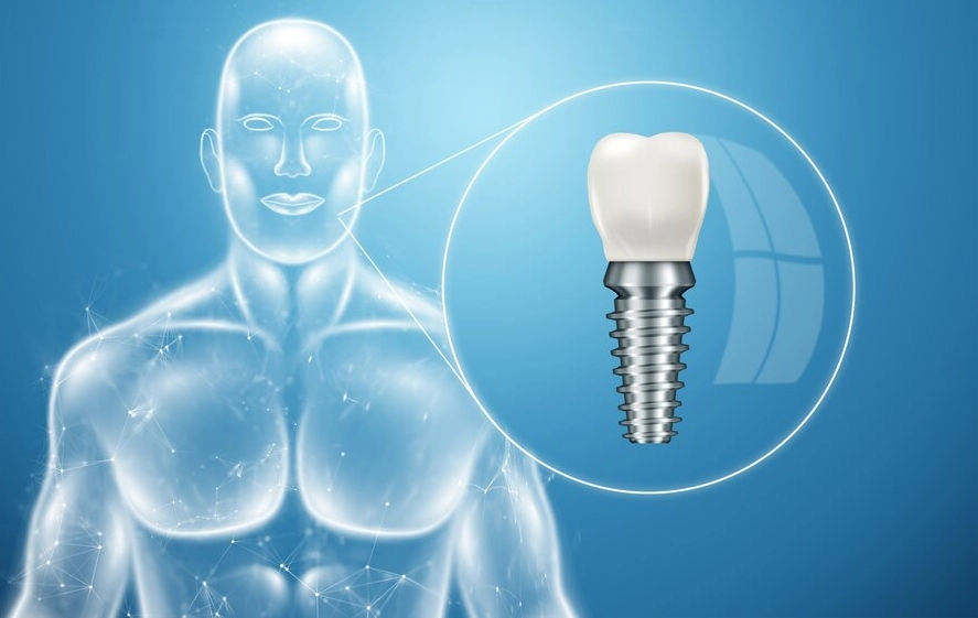 The Risks of Dental Implant Surgery