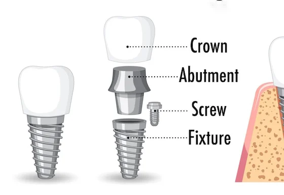 Risks and Advantages of Dental Implant