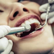 Dental Crown and Bridge Treatment in Wakad