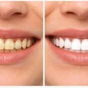 Dr. Ankush R. Agrawal providing best dental care and whitening in Wakad