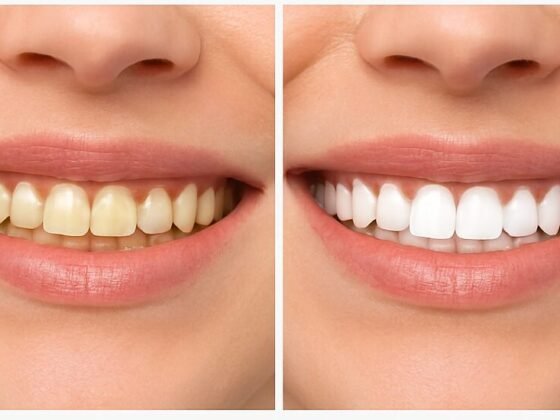 Before and After: Amazing Teeth Whitening Results at Dentsee Wakad